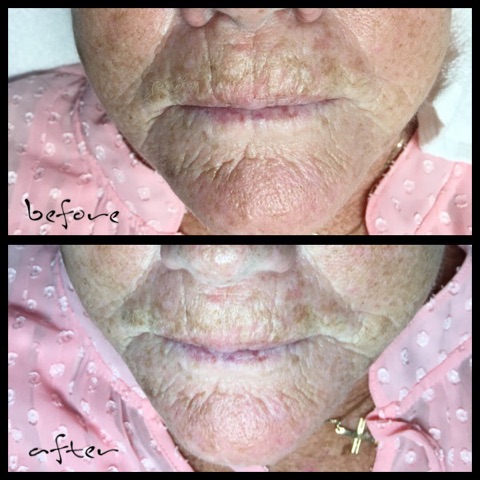 Oxygen Facials