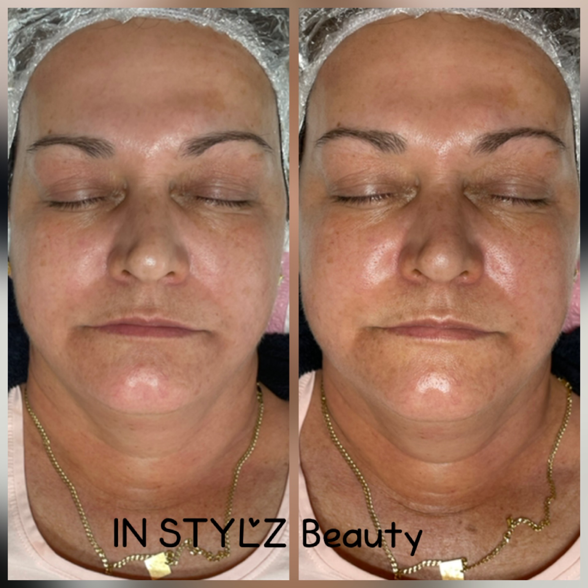 Oxygen Facials